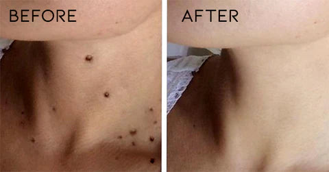 Fivfivgo™ WipeOff Tags & Mole Remover