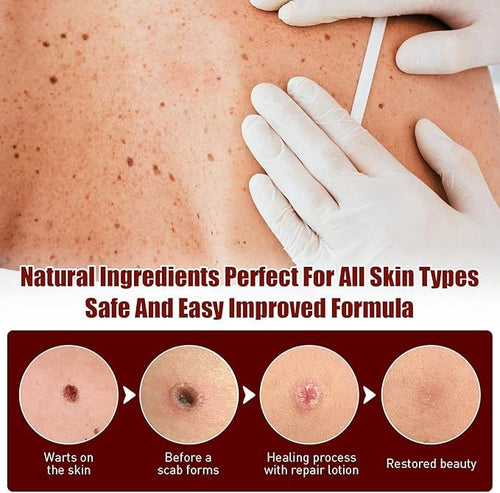 Fivfivgo™ WipeOff Tags & Mole Remover